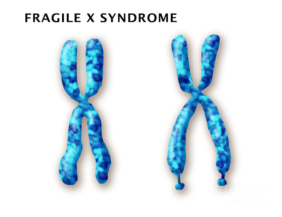 سندرم ایکس شکننده (Fragile X syndrome)