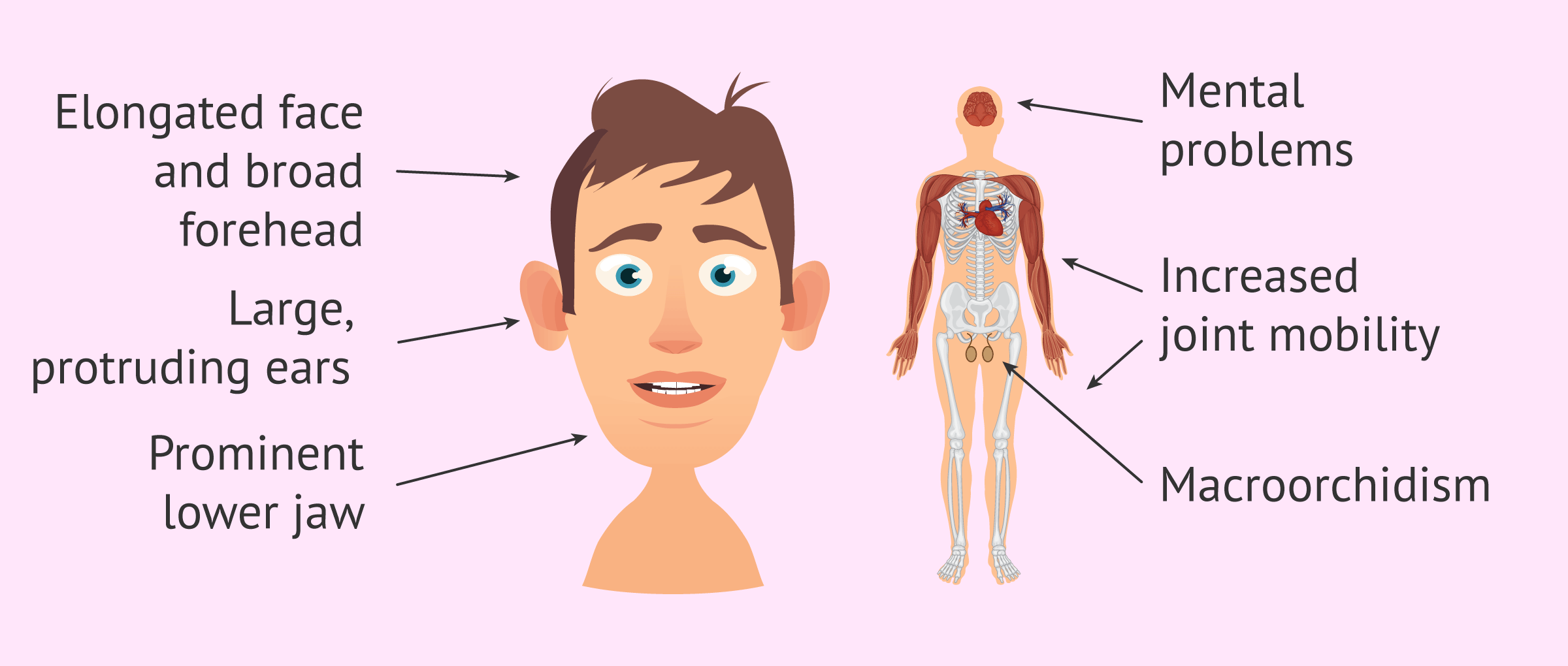 سندرم ایکس شکننده (Fragile X syndrome)