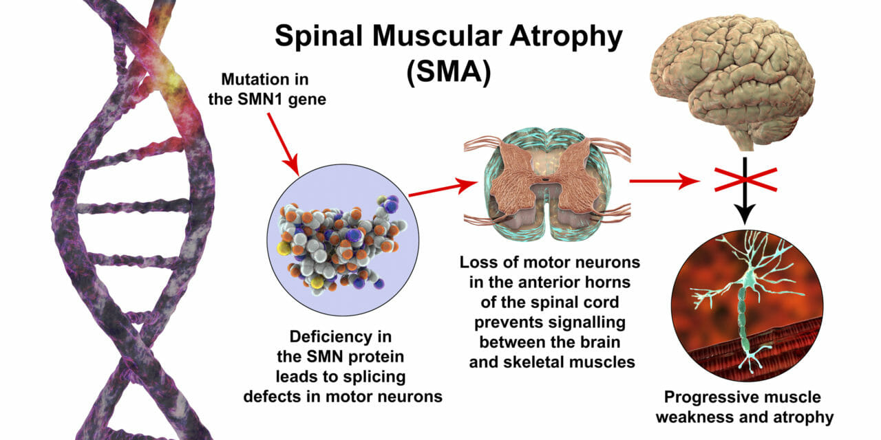 بیماری SMA (spinal muscular atrophy)